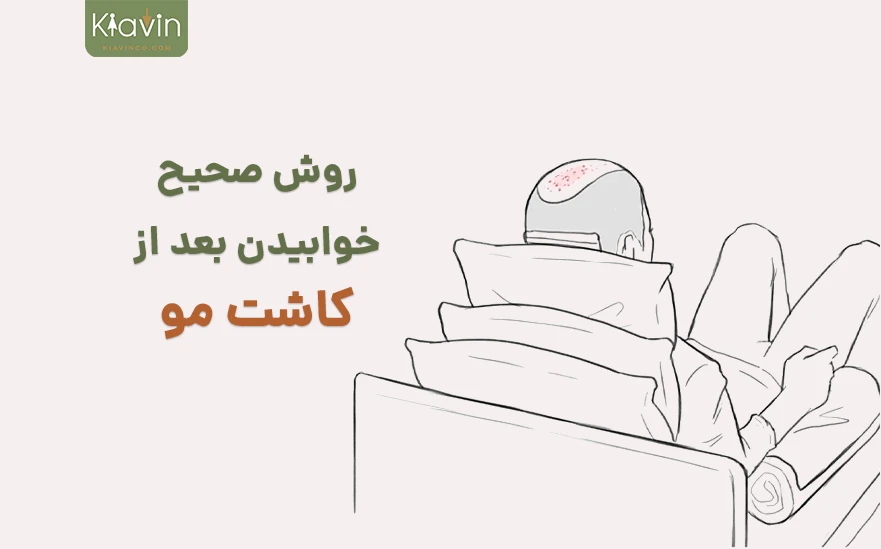 برای مراقبت از موهای کاشته شده چطور بعد از عمل کاشت مو بخوابیم؟