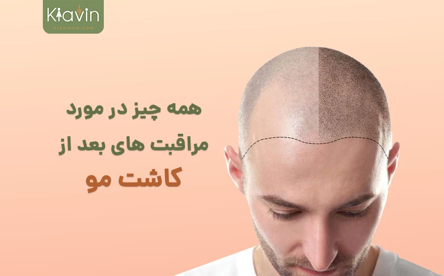 راهنمای گام به گام مراقبت های بعد از کاشت مو