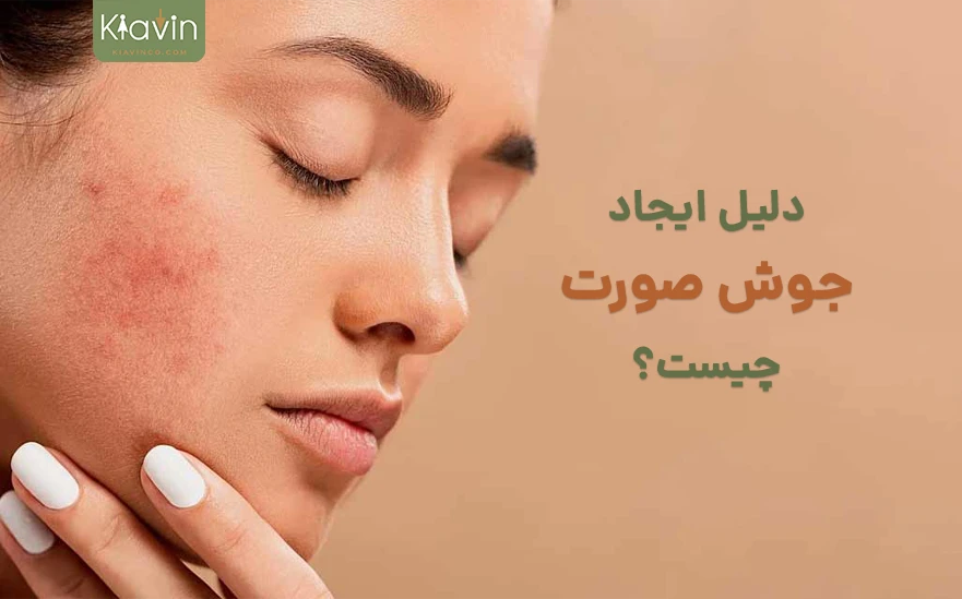 علت جوش زدن صورت چیست؟